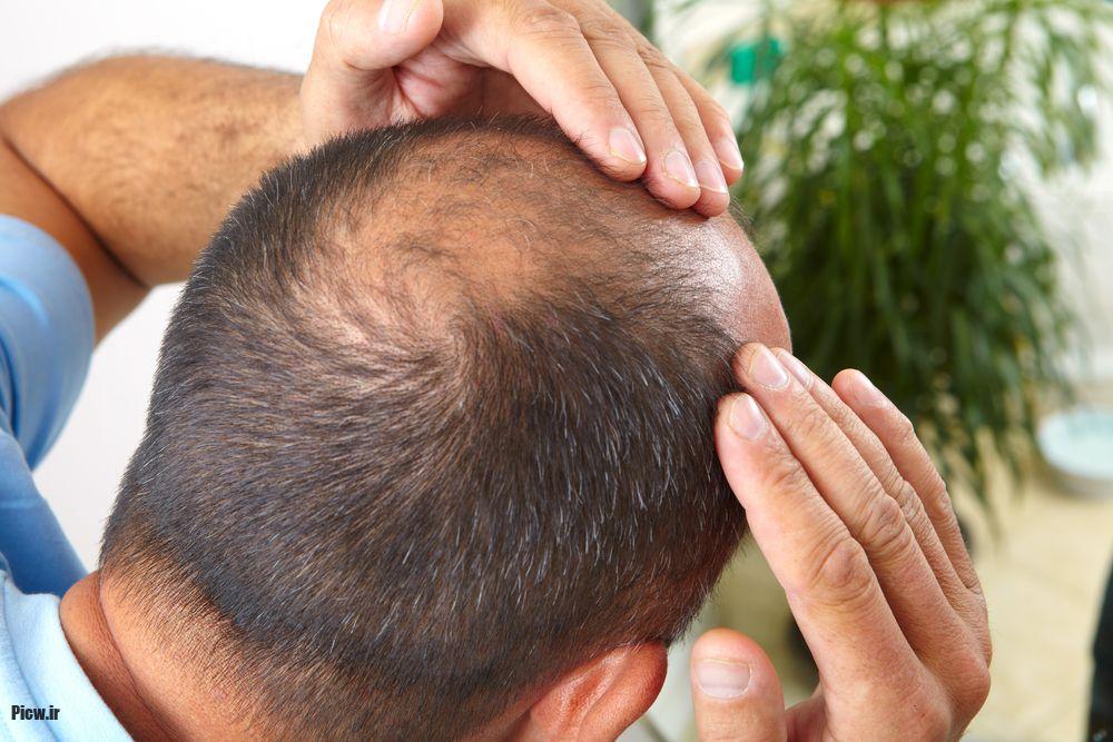 جلوگیری از ریزش مو