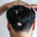 جلوگیری از ریزش مو