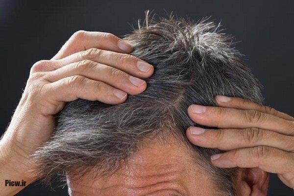 ریزش مو