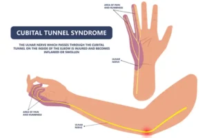 علل و علائم سندروم تونل کوبیتال